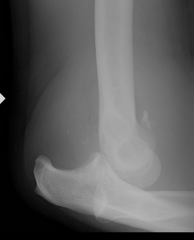Elbow Dislocation Lateral